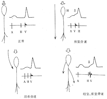 预激综合征