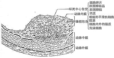 动脉粥样硬化