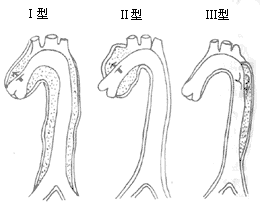 主动脉瘤