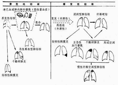 肺结核