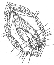 腹股沟斜疝