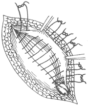 腹股沟斜疝