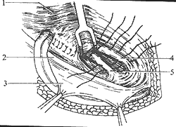 腹股沟斜疝