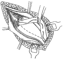 腹股沟斜疝