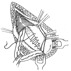 腹股沟斜疝