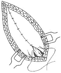 腹股沟斜疝