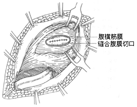 腹股沟滑动性疝