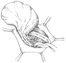 腹股沟滑动性疝