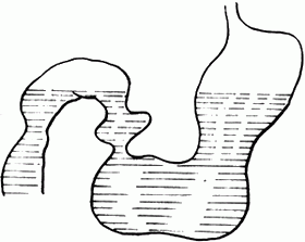 环状胰腺
