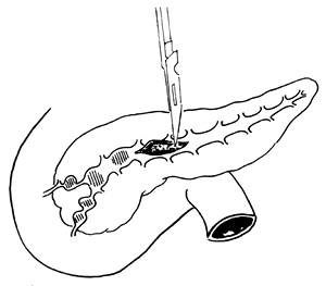 慢性胰腺炎