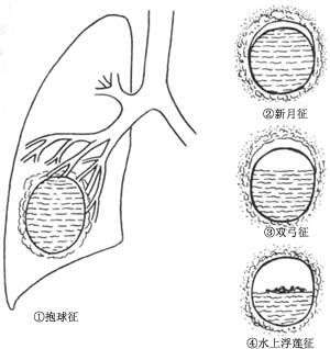 肺包虫病