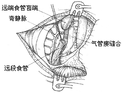 先天性食管闭锁