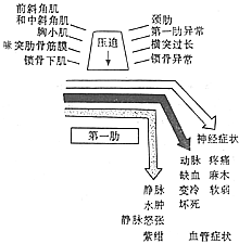 胸廓出口综合征