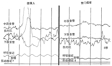 贲门痉挛