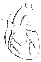 主动脉瓣疾病