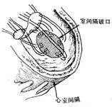 心肌梗塞并发心室间隔穿破