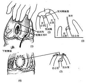 心肌梗塞并发心室间隔穿破