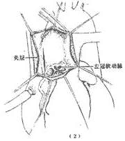 胸主动脉夹层动脉瘤