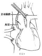 胸主动脉夹层动脉瘤