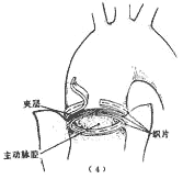 胸主动脉夹层动脉瘤