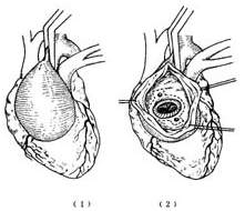 胸主动脉夹层动脉瘤