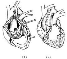 胸主动脉夹层动脉瘤