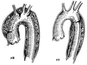 胸主动脉夹层动脉瘤