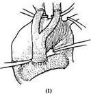 胸主动脉弓动脉瘤