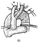 胸主动脉弓动脉瘤