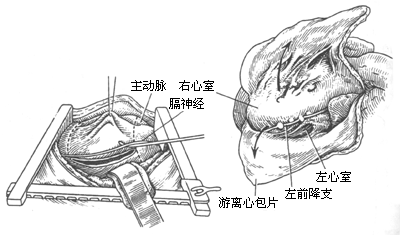 慢性缩窄性心包炎