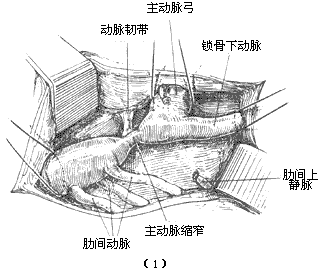 先天性主动脉缩窄