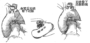 先天性主动脉弓畸形