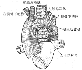 先天性主动脉弓畸形