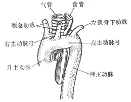 先天性主动脉弓畸形