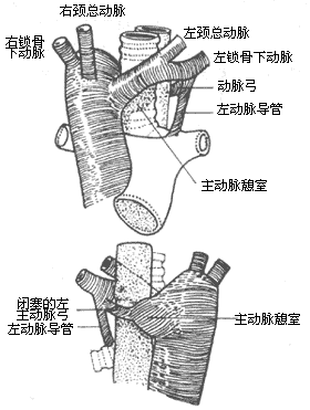 先天性主动脉弓畸形