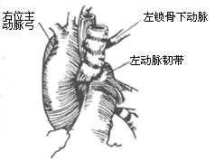 先天性主动脉弓畸形