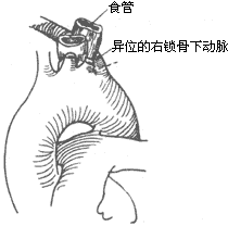 先天性主动脉弓畸形