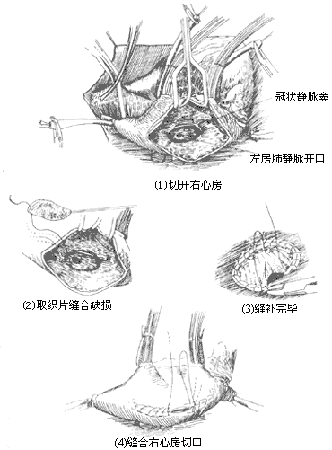 心房间隔缺损