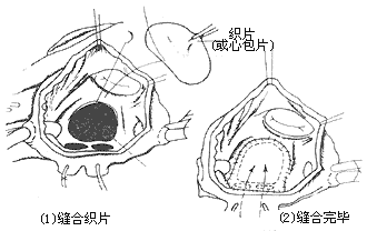 心房间隔缺损