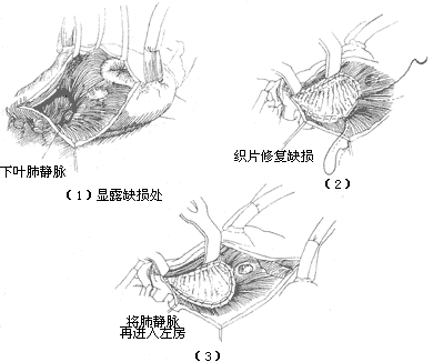 心房间隔缺损