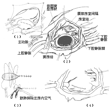 心房间隔缺损