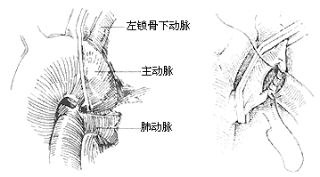 法乐四联症