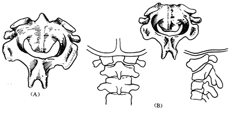 先天性颈椎齿状突畸形