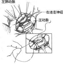 法乐四联症