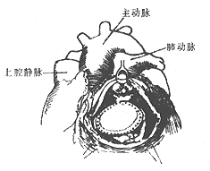 法乐四联症