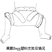 先天性髋脱位