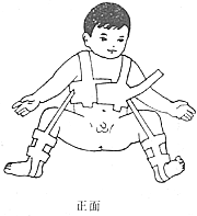 先天性髋脱位