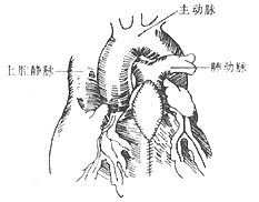 法乐四联症