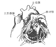 法乐四联症