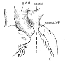 法乐四联症